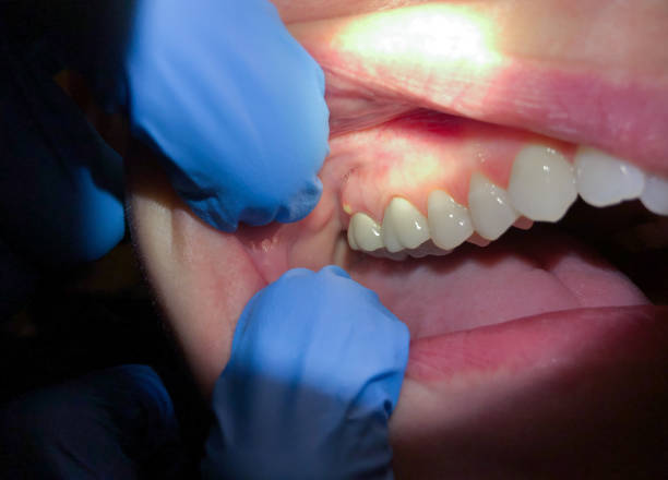 Best Emergency Root Canal Treatment in Arcadia, SC