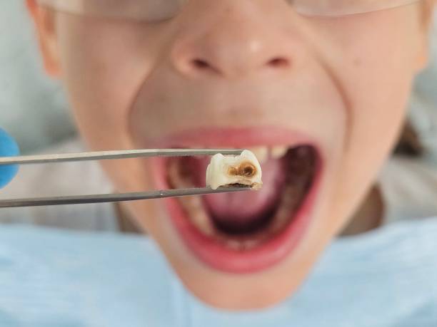 Best Emergency Dental Care for Broken or Chipped Teeth in Arcadia, SC